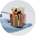 Root Canal Treatment